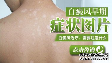 深圳白癜风医院